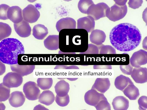 IG - Granulócitos Imaturos - Um Excelente Marcador Inflamatório
