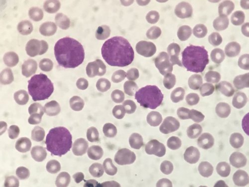 Leucemia Promielocitica Aguda variante Hipogranular