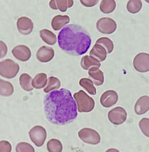 LPA variante hipogranular