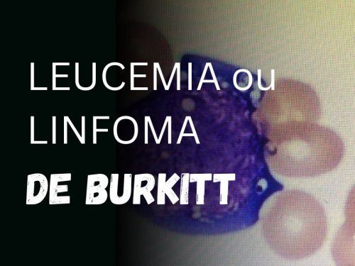 Leucemia ou Linfoma de Burkitt: Entenda a Atualizao na Classificao